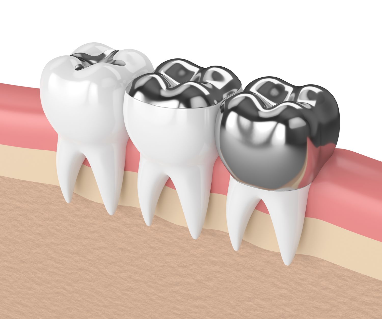 Children's Dentistry: Stainless steel crowns